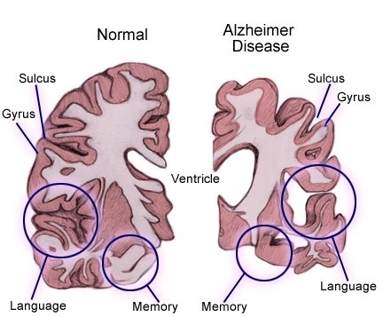 Alzheimer cetosis